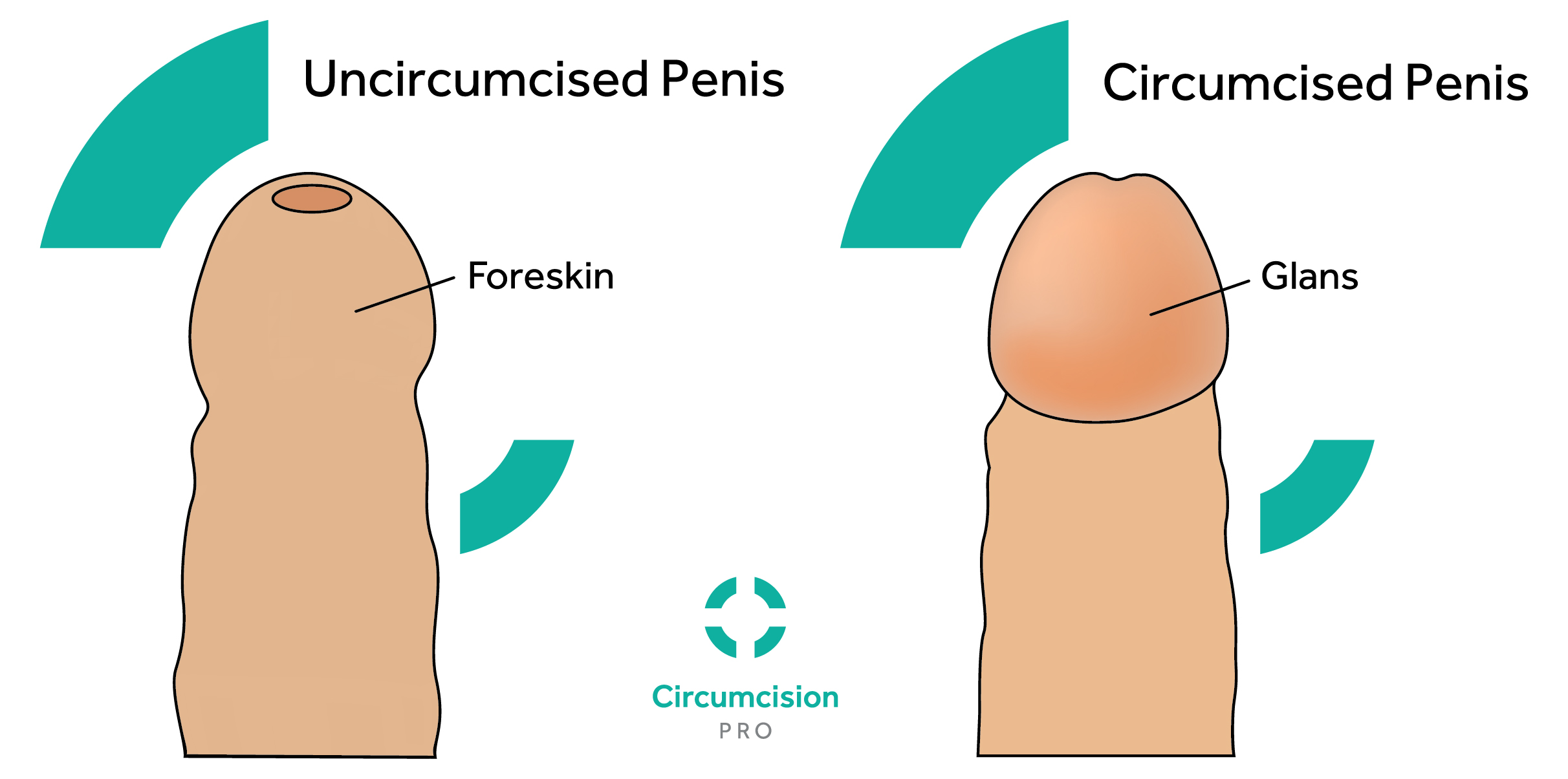 Are uncircumcised people more sensitive? 