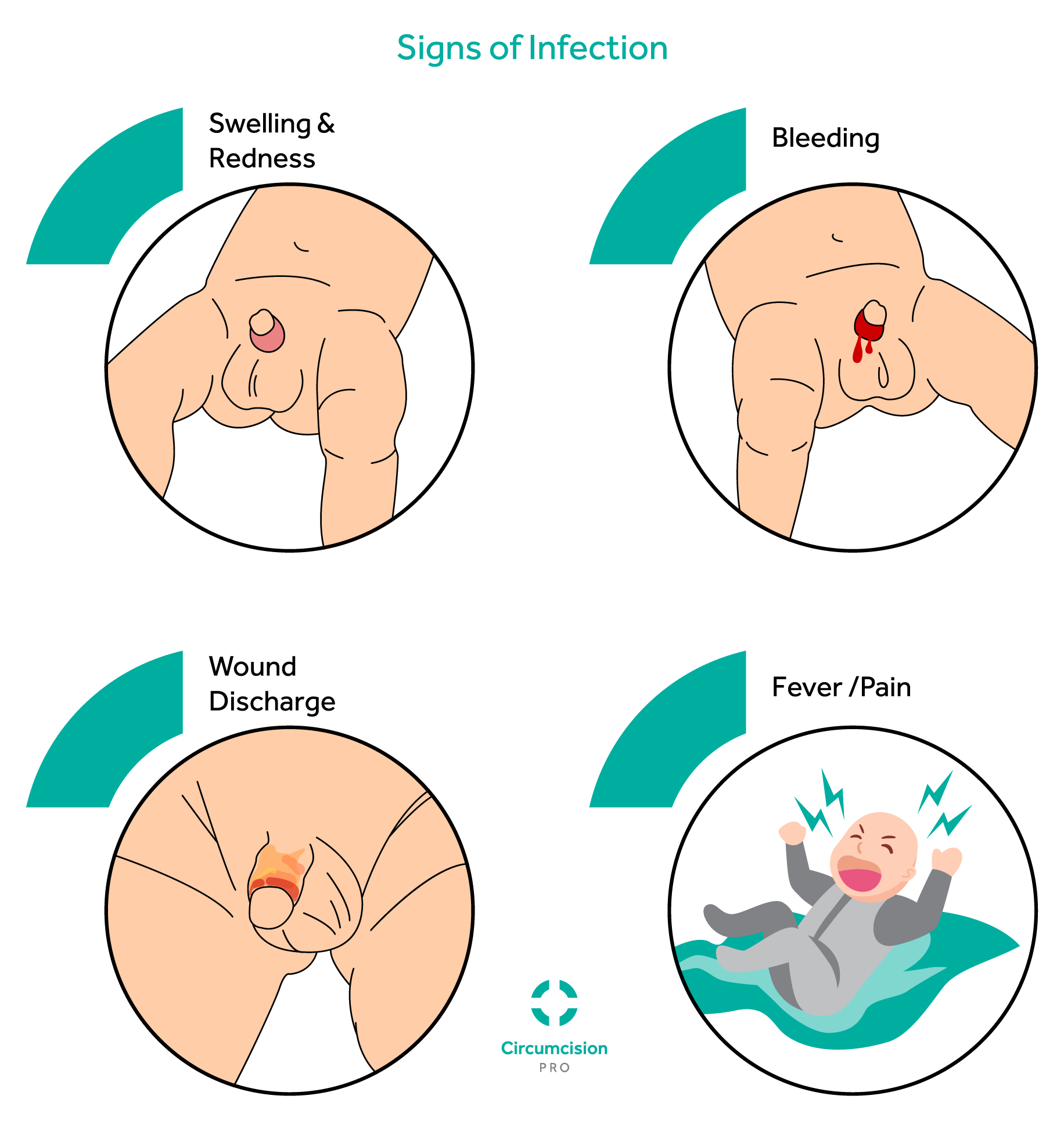 baby circumcision infection