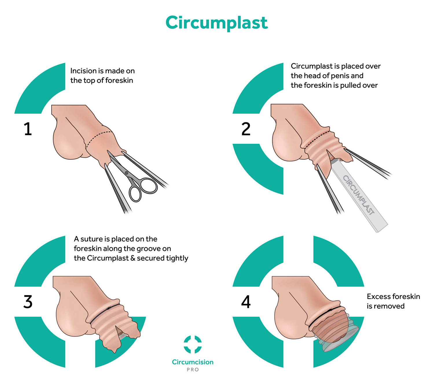 Newborn Circumcision: The Gomco Method | Consultant360