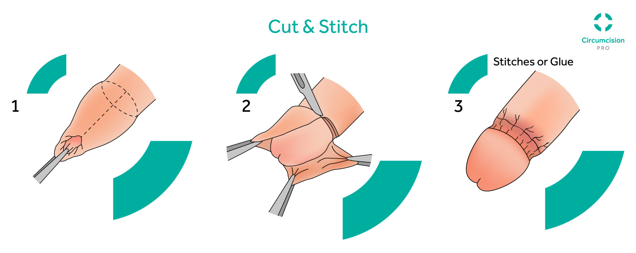 Techniques of Circumcisions — London Circumcision Clinic | Paediatric  Surgeon/Urologist