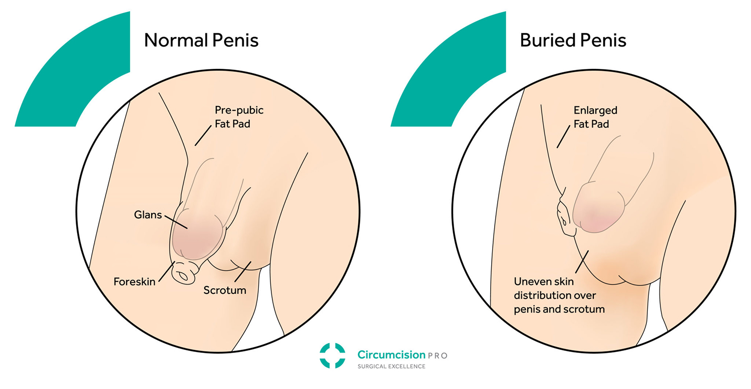 Stapler circumcision | Improve fertility, Circumcision, Stapler