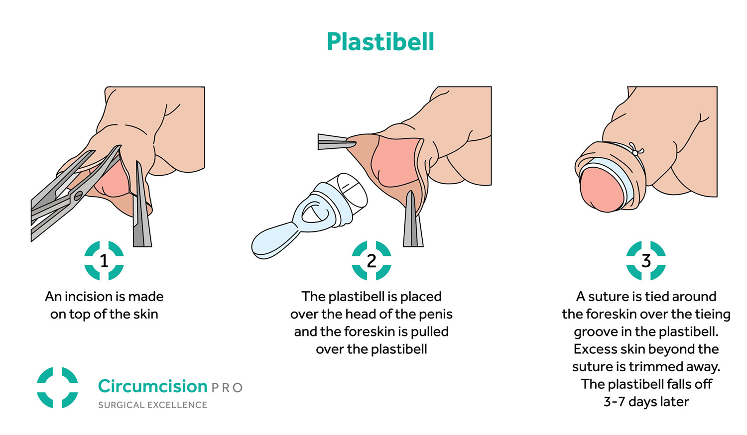 Circumplast vs Plastibell circumcision - YouTube