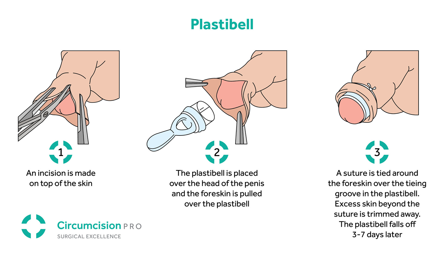 Adult Circumcision - Circumcision Vasectomy Australia